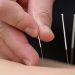 The Benefits of Acupuncture for Pain Management