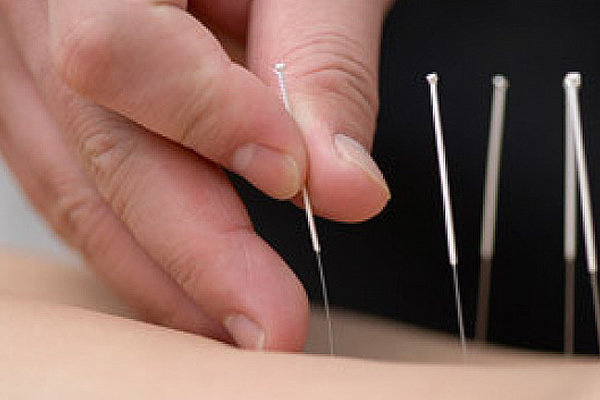 Benefits of Acupuncture